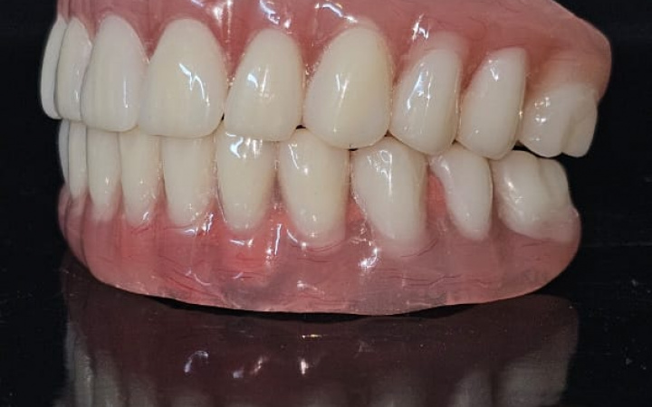 Aligners – neviditeľné strojčeky pre modernú ortodonciu